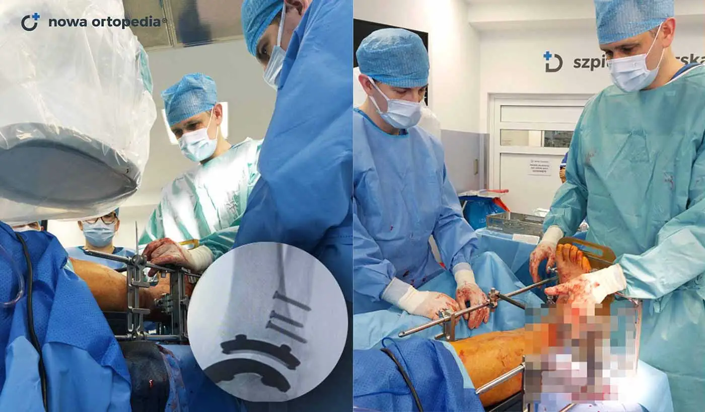 Innowacyjny zabieg endoprotezy stawu skokowego z dostępu bocznego w Nowej Ortopedii!