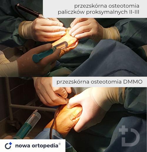 operacja bolesnego przodostopia - małoinwazyjne osteotomie paliczków i kości śródstopia DMMO frezem kostnym