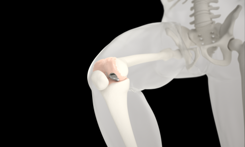 endoproteza powierzchniowa kolana episurf