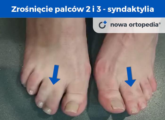 Syndaktylia zrośnięcie palców zdjecie stopy