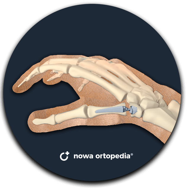 endoproteza stawu kciuka