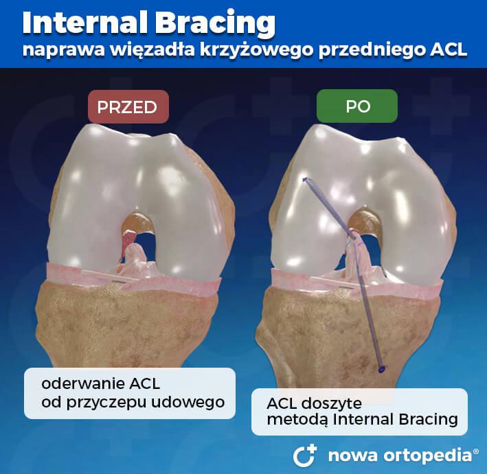 internal bracing acl kolana