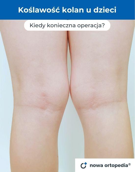 koslawosc kolan u dzieci kiedy operacja