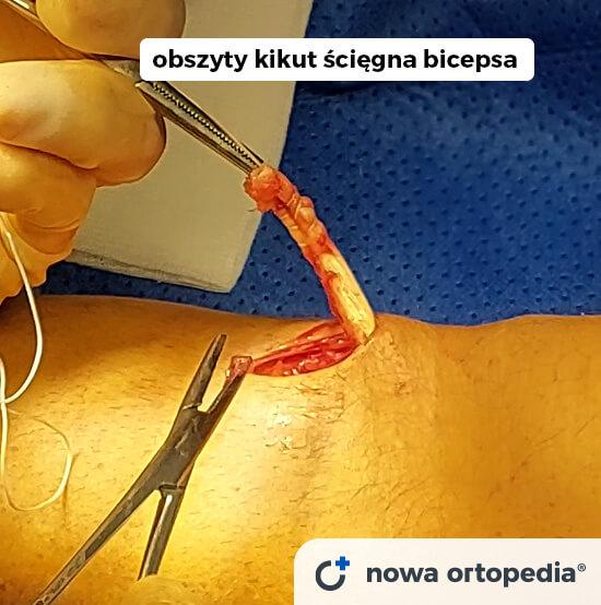 operacja bicepsa obszyty kikut sciegna
