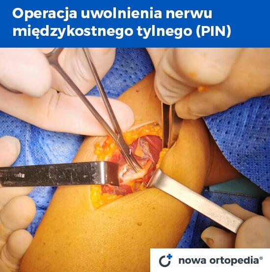 operacja uwolnienia nerwu międzykostnego tylnego