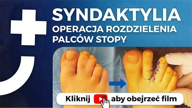 Syndaktylia Operacja Rozdzielenia Palców U Stóp Szpital Dworska 2506