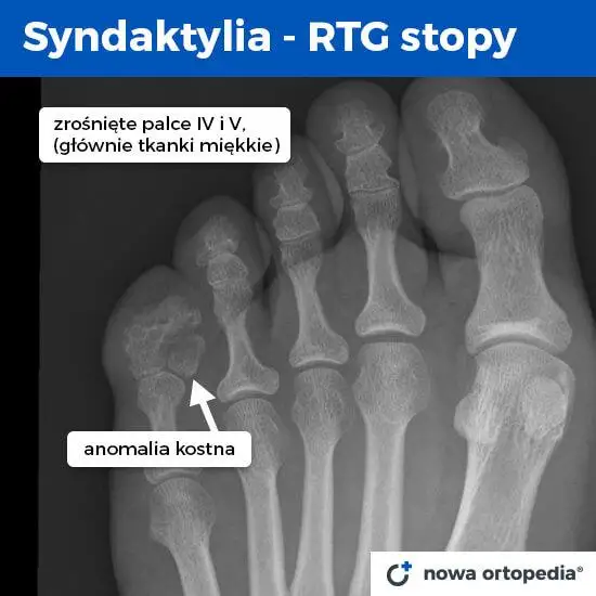 Syndaktylia Operacja Rozdzielenia Palców U Stóp Szpital Dworska 0771